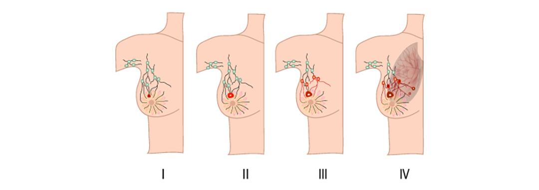Stages of breast cancer 