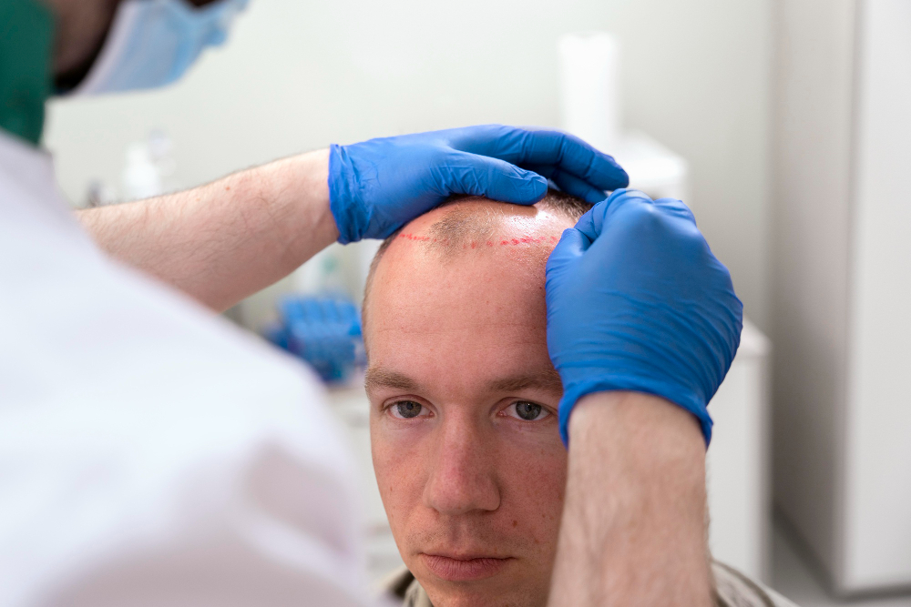 Top 5 Hospitals for Hair Transplant in Turkey