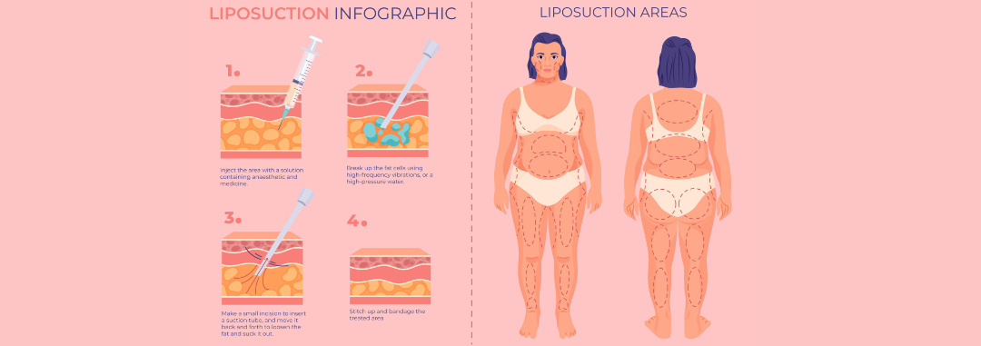 Liposuction infograpghic with Utmost Patient Safety