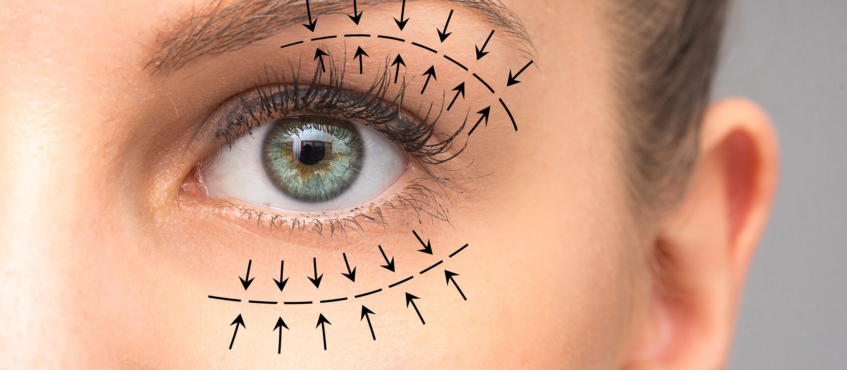 Best Hospitals for Eyelid Surgery in South Korea for International Patients