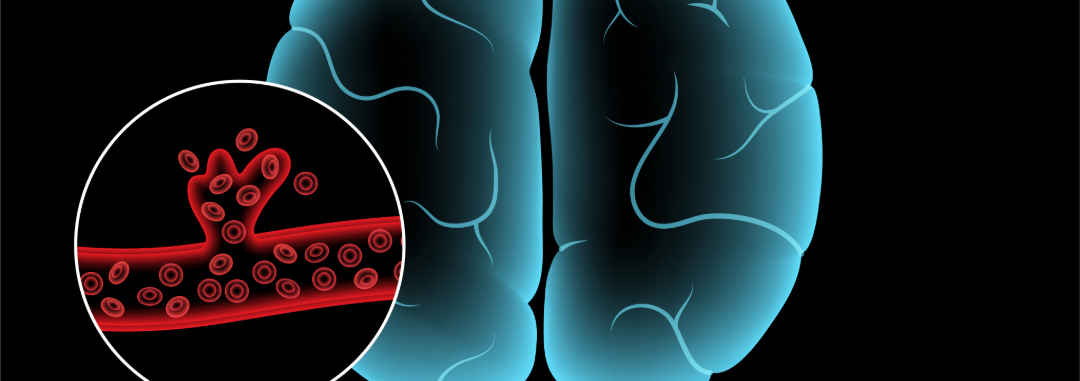 Hemorrhagic Stroke Visual Representation