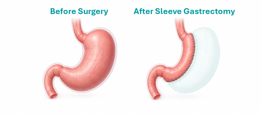 Gastric Sleeve Surgery in Turkey: Cost, Packages and Recovery