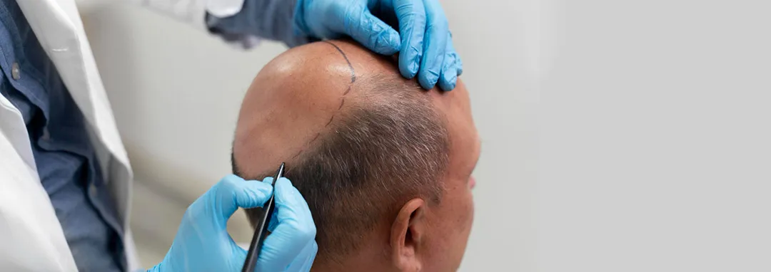 Hair Transplant in Turkey - Acibadem Hospital