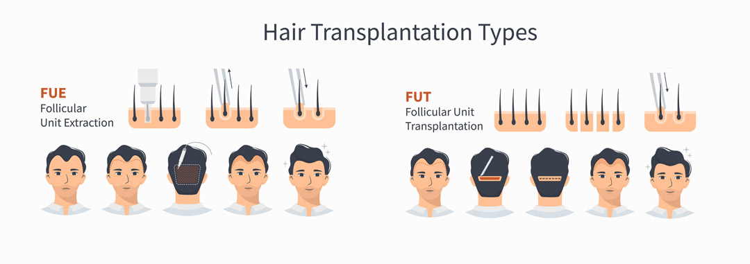 Advanced Hair Transplant Techniques Available at Acibadem Hospital