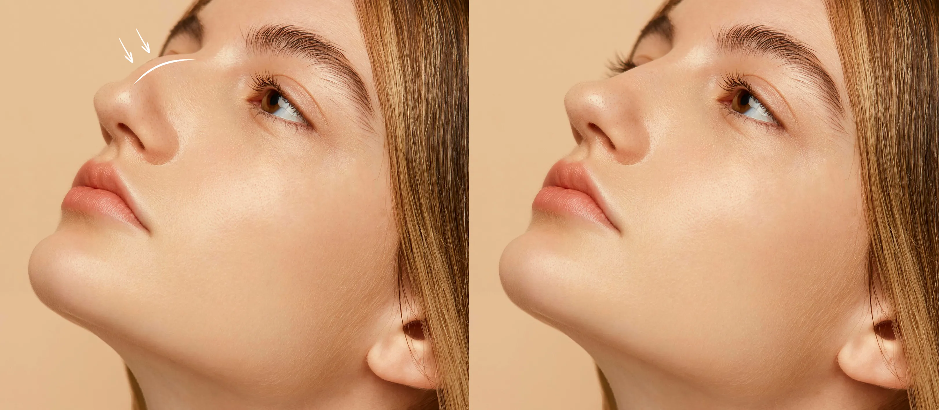 Rhinoplasty (Nose Job) in South Korea