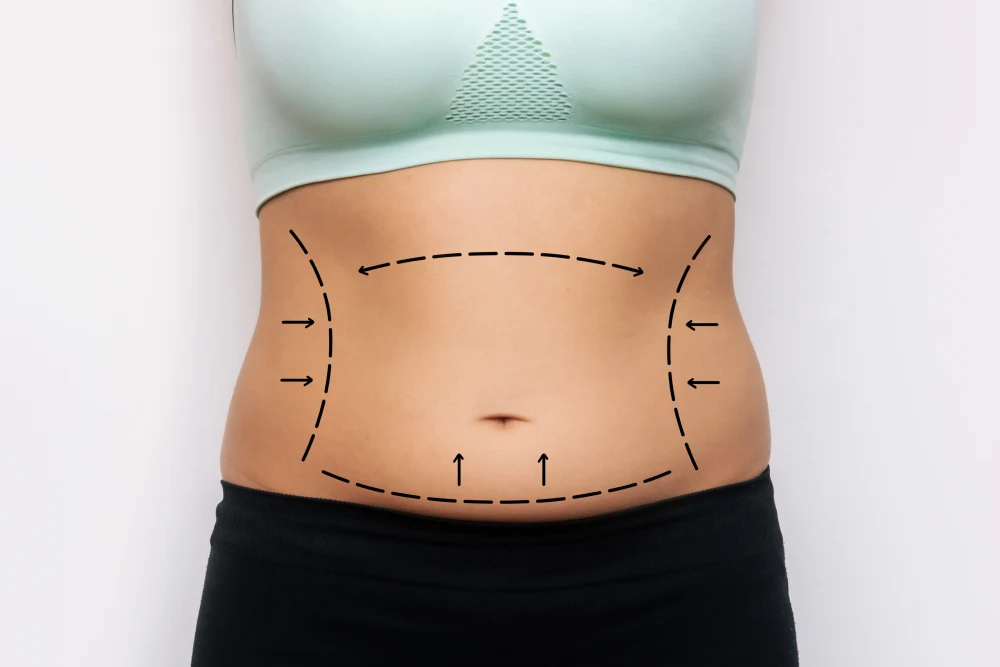 Abdominoplasty (Tummy Tuck)
