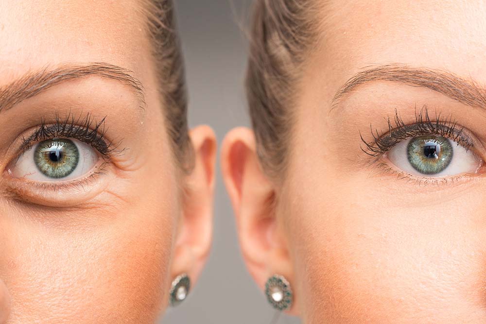 Advanced Upper & Lower Blepharoplasty (Eyelid Surgery)