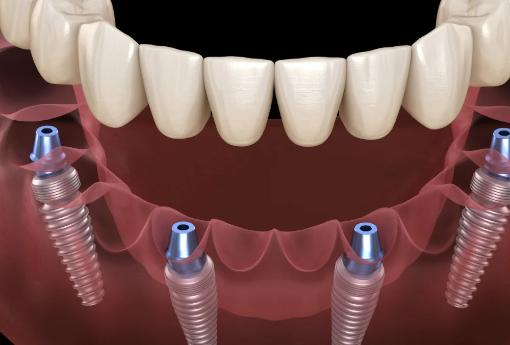 All On 4 + 12 Ziconium Crowns (Per Jaw)