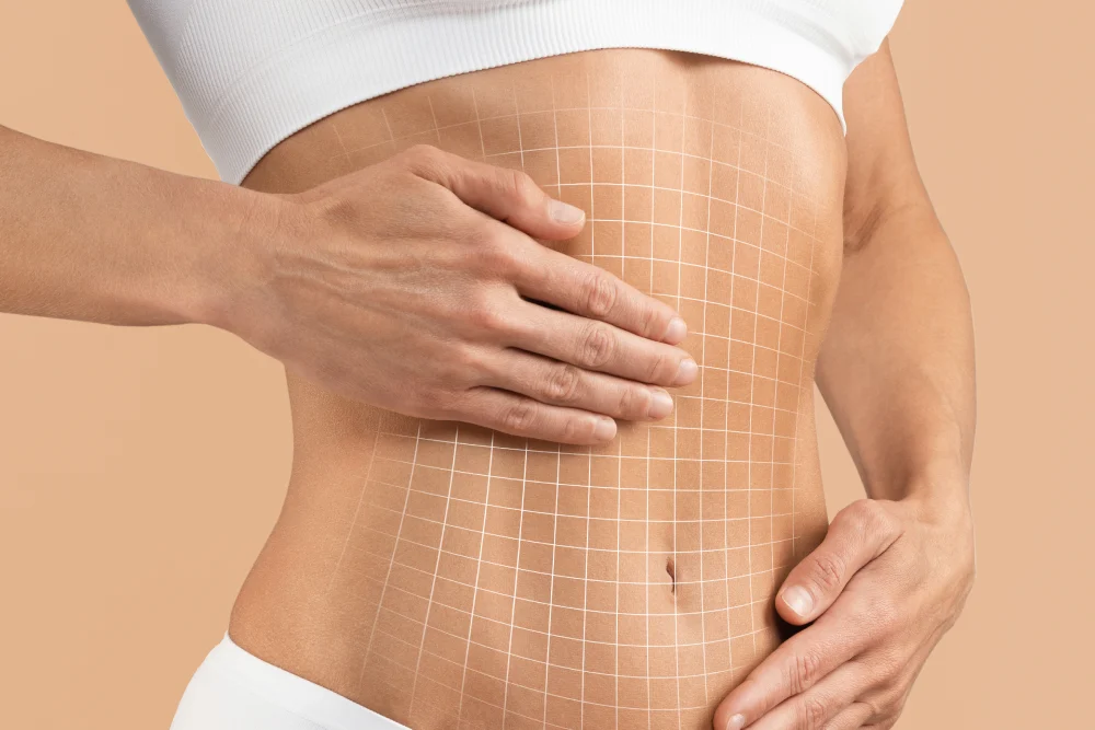 Belt Abdominoplasty/Body Lift (Abu Dhabi)
