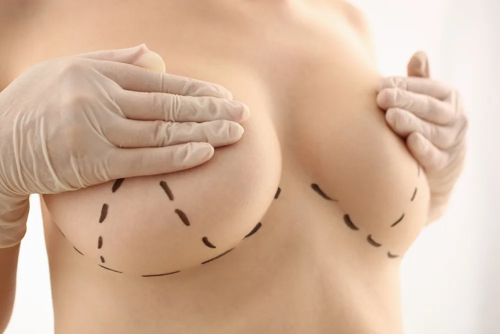 Breast Reduction