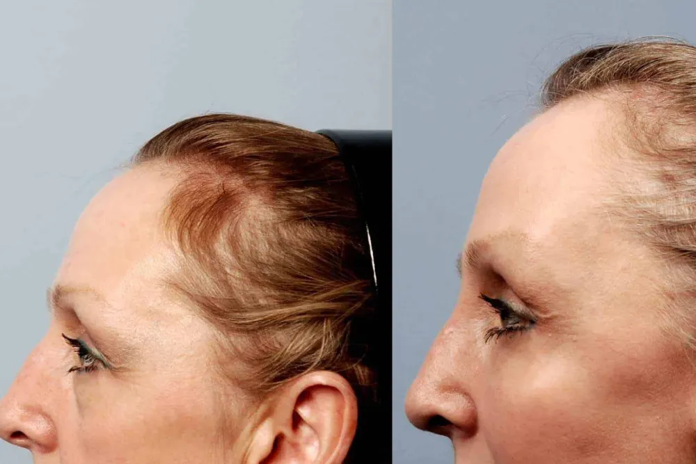 Forehead Lift