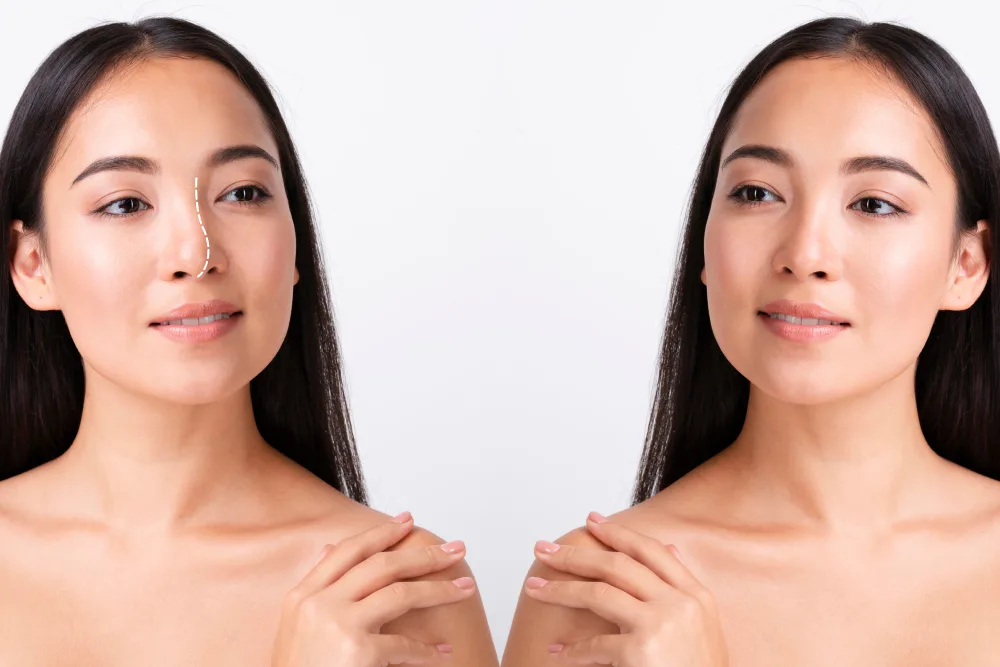 Full Rhinoplasty (Bridge + Tip)