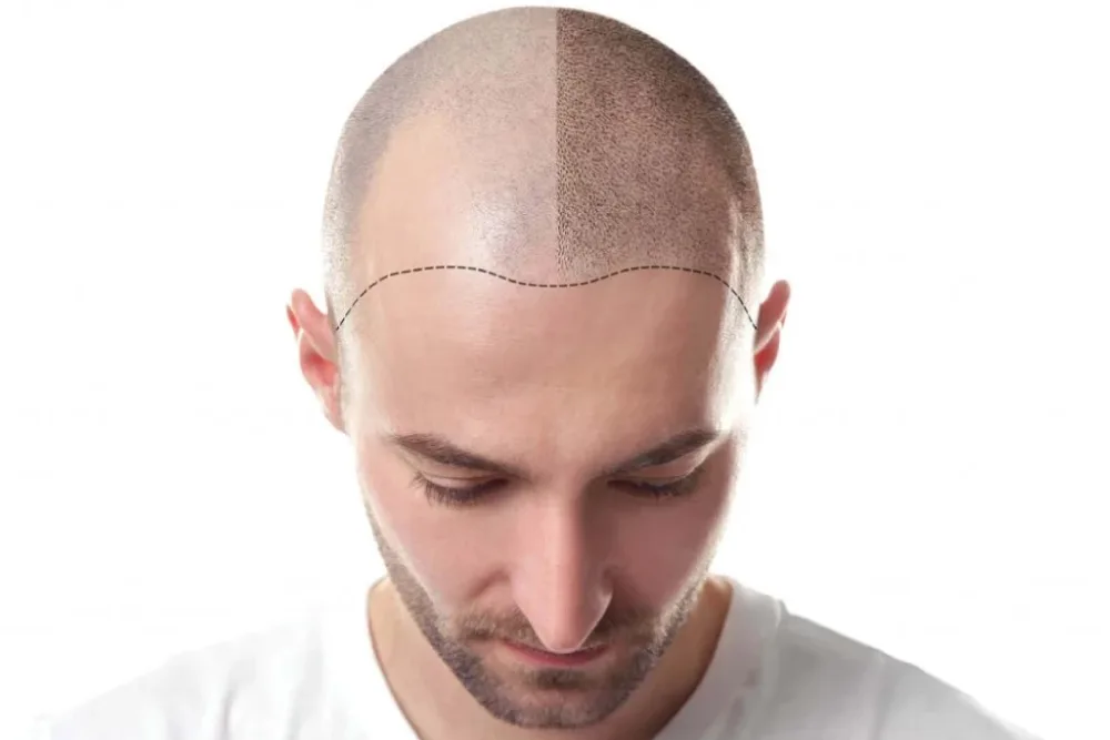 Hair Transplantation (DHI)