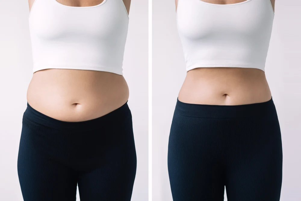 Liposuction (Abdomen)