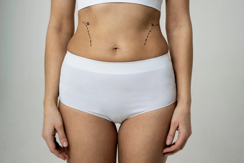 Mini Tummy Tuck