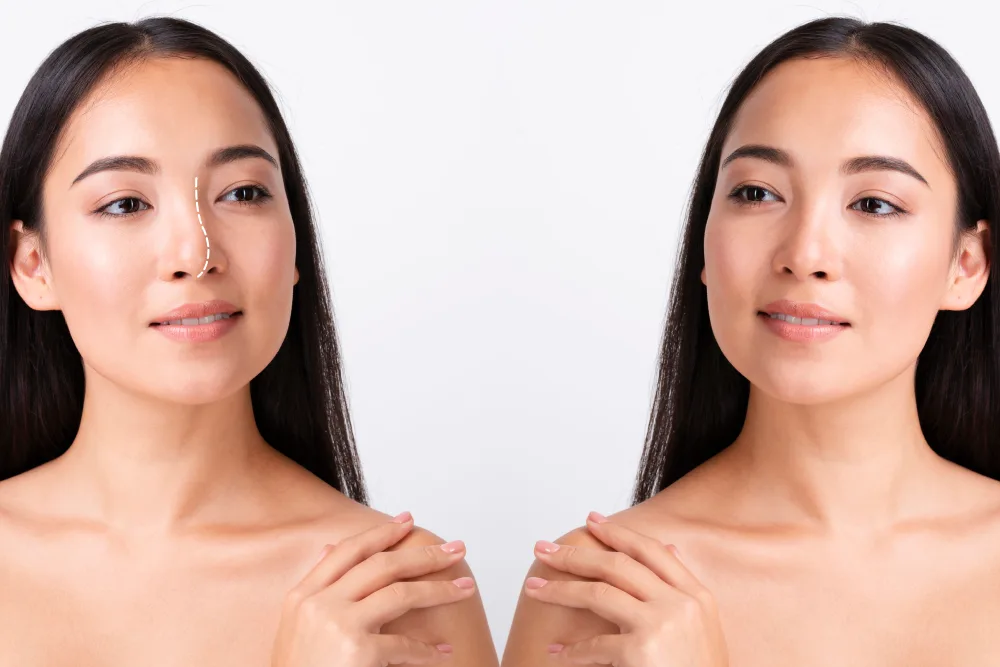 Rhinoplasty + Tip Plasty