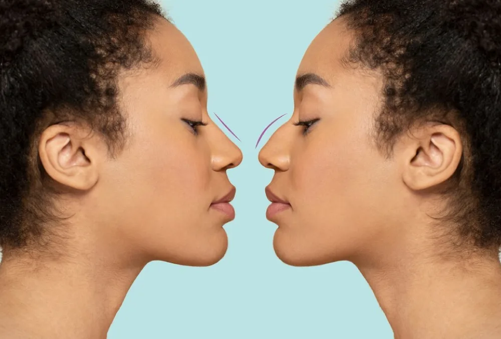 Rhinoplasty