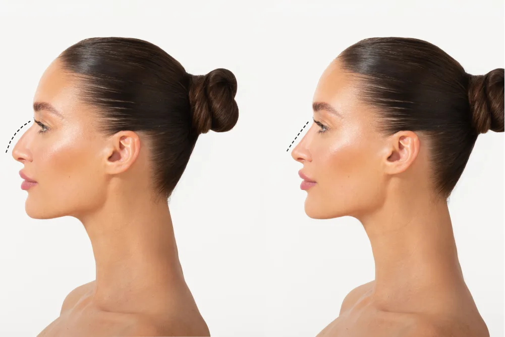 Simple Rhinoplasty (Nose Bridge Only)