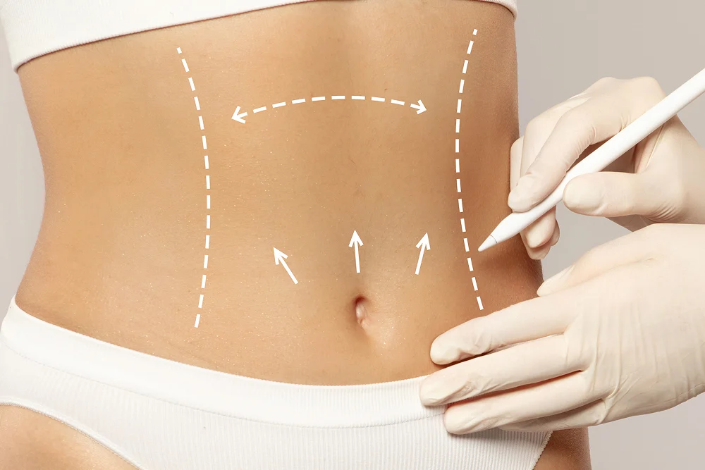 Tummy Tuck – 1 Day