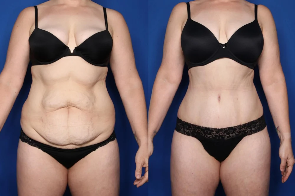 Tummy Tuck