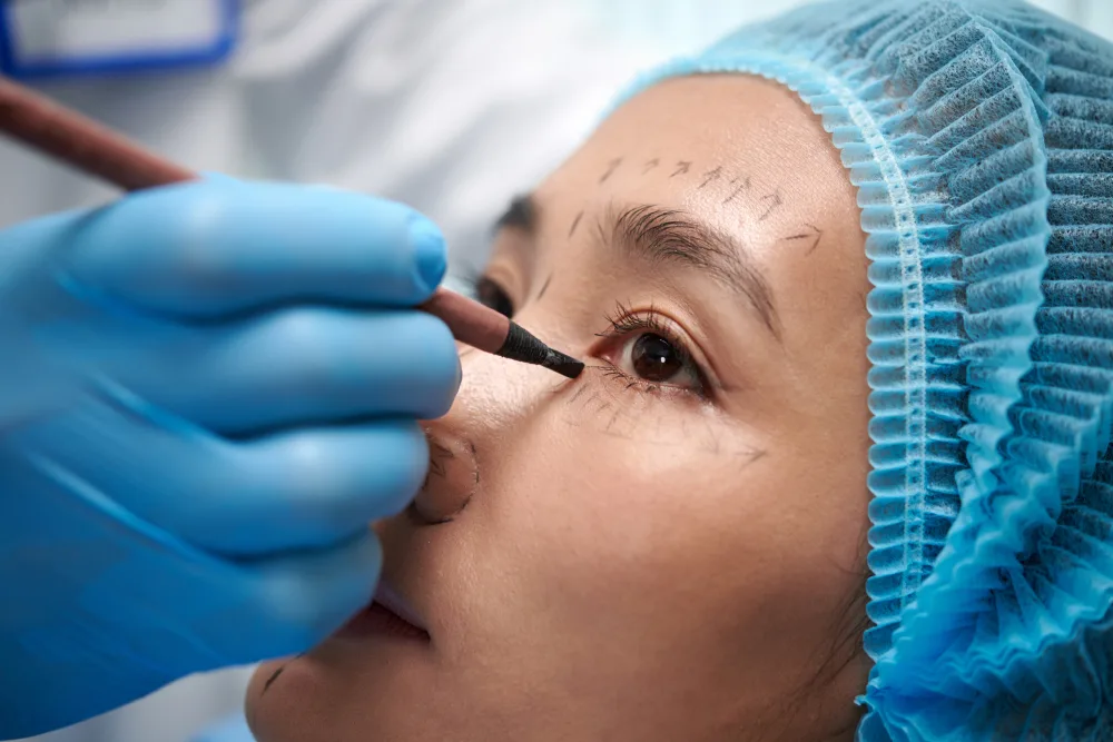Upper Blepharoplasty