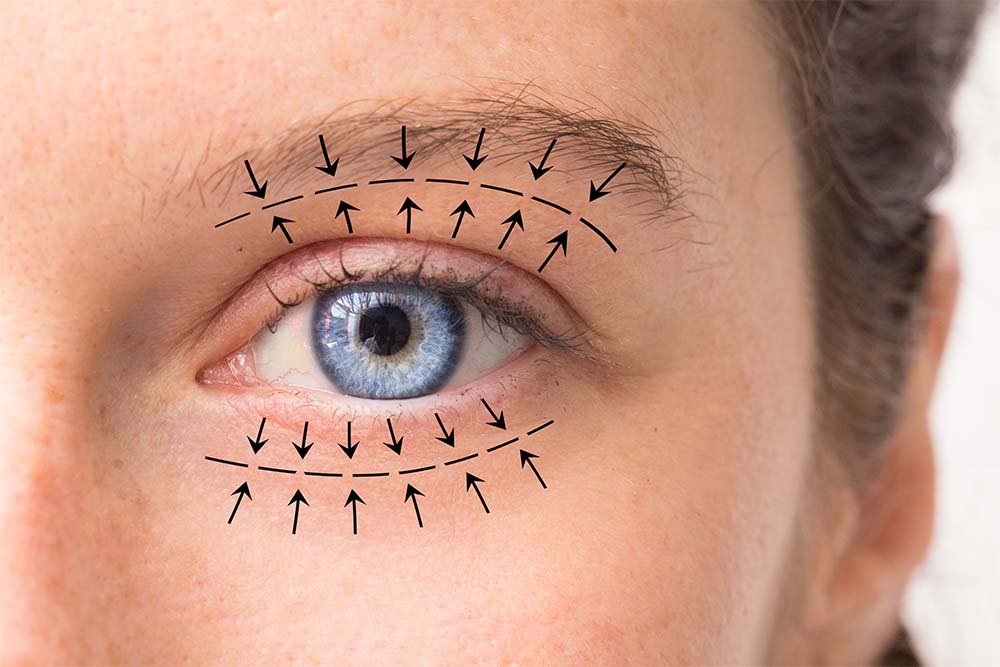 Upper or Lower Blepharoplasty (Eyelid Surgery)